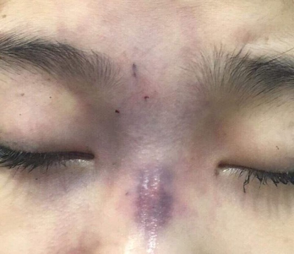 Chồng tiêm filler làm mù mắt vợ - 1 Bệnh nhân bị tắc động mạch võng mạc trung tâm gây mù mắt phải sau khi tiêm filler. Ảnh: BSH