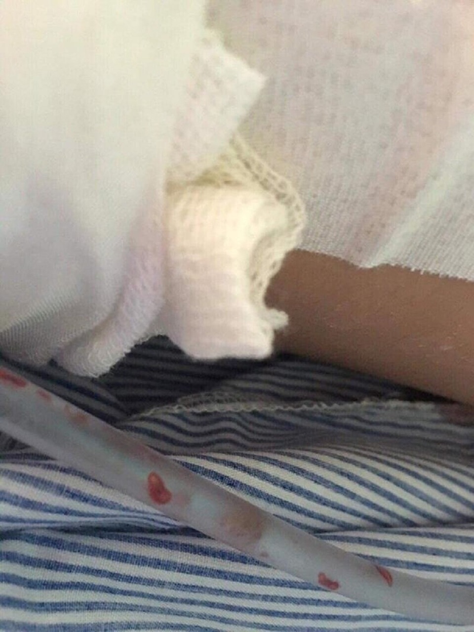 Sốc: Ký sinh trùng theo dịch phổi bệnh nhân ra ngoài - 1 Ký sinh trùng được hút ra theo dịch phổi. Ảnh: LT