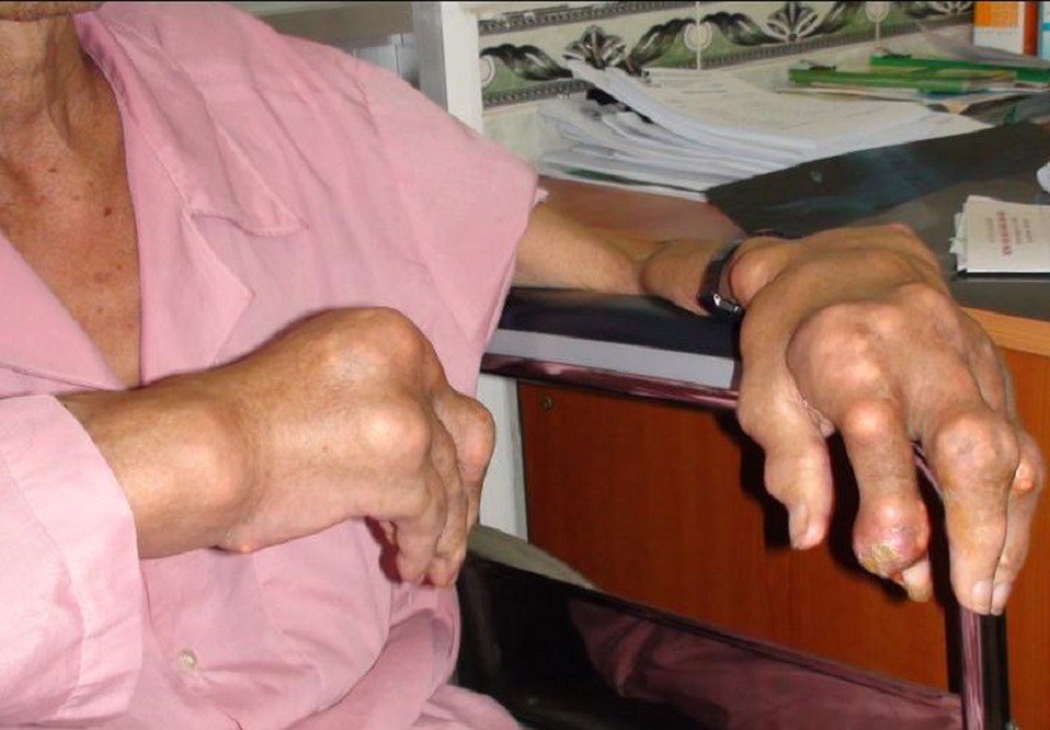 Kết hợp đông tây y trong đẩy lùi bệnh gút - 1 Gút là căn bệnh gây ra nhiều đau đớn cho người bệnh, tạo gánh nặng xã hội