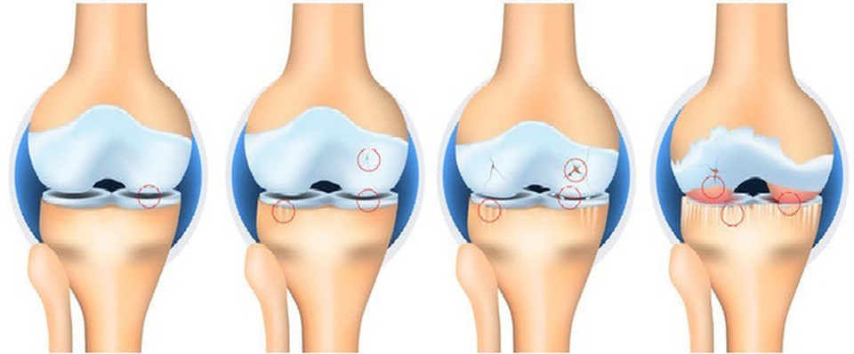 Giải pháp toàn diện cho bệnh nhân thoái hóa khớp - 1 Các giai đoạn của bệnh thoái hóa khớp