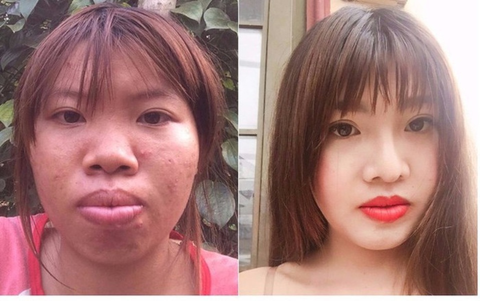 Những cô gái từng bị chê “xấu như thị nở” lột xác ngoạn mục gây sốt cộng đồng - 1 Phượng trước và sau khi phẫu thuật thẩm mỹ