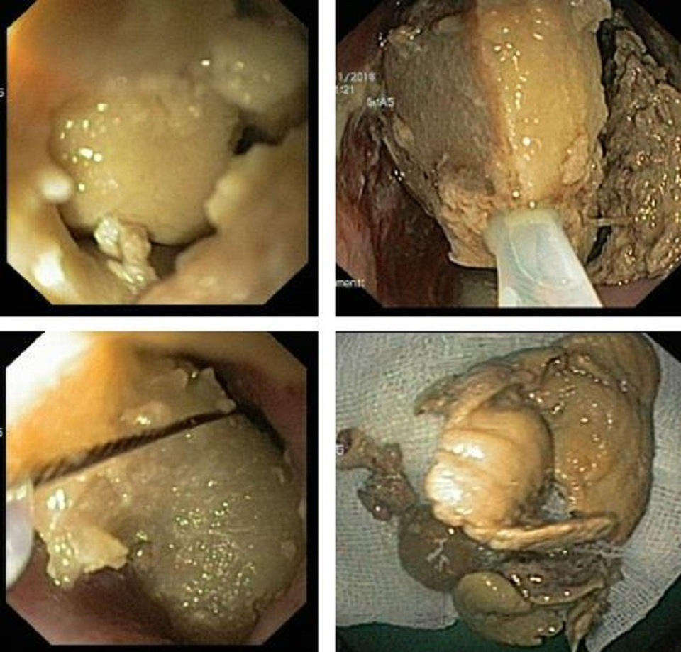 Loét thực quản vì nghẹn mề gà 5 ngày không biết - 1 Khối mề gà được phát hiện qua hình ảnh nội soi thực quản