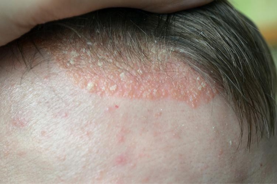 Bệnh vảy nến và những biến chứng nguy hiểm khôn lường - 1 Dấu hiệu vảy nến da đầu