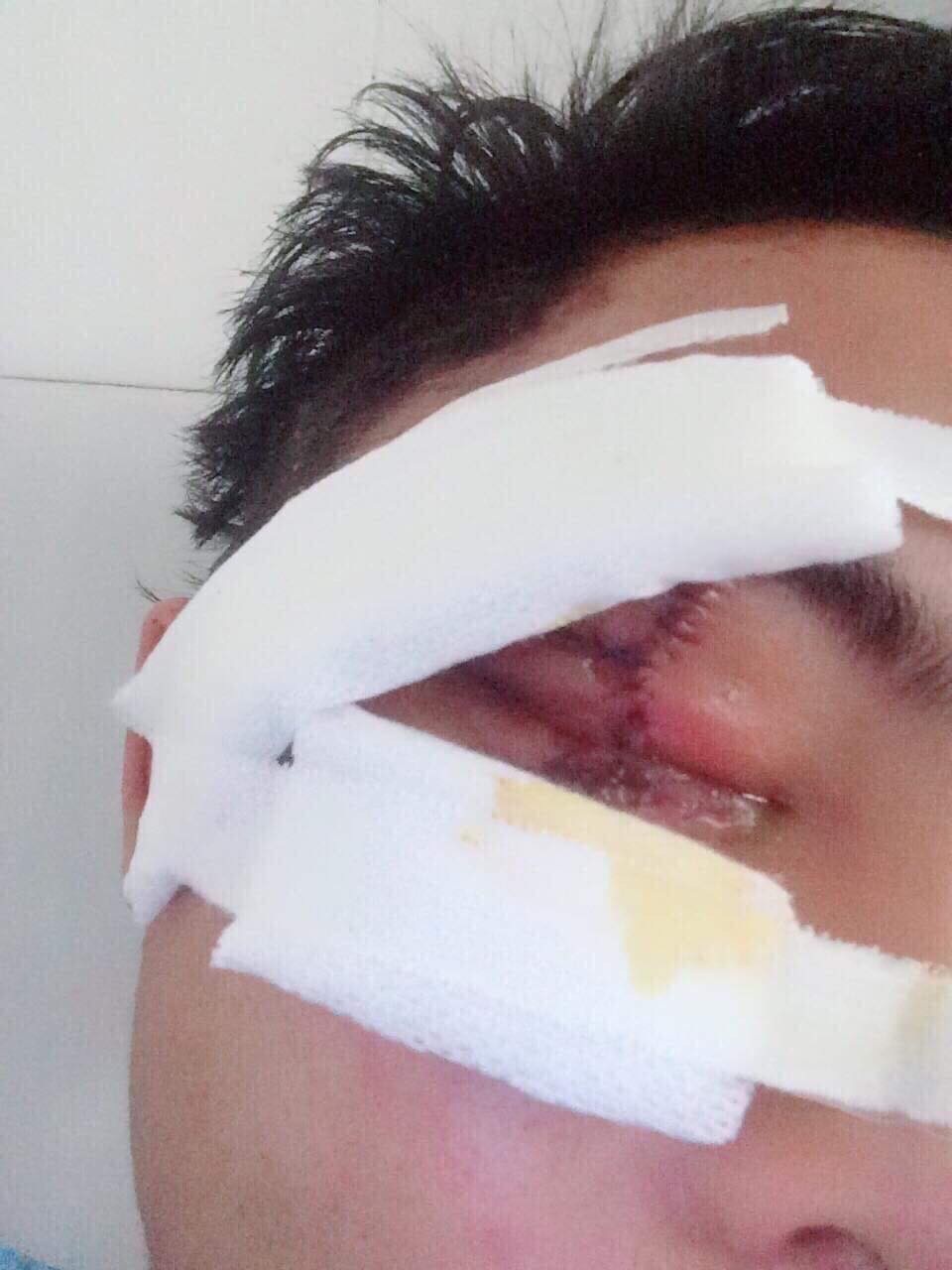 Xót thương cuộc sống khốn cùng của gia đình bị "trời đày" - 12 Cậu con trai út bị tai nạn trên đường đi học về khi toàn bộ xương phần răng hàm mặt gãy, não ảnh hưởng khiến chị phải vay mượn khắp nơi lo cho Tâm 3 lần phẫu thuật. Hiện cháu Tâm đang được điều trị tại BV Mắt trung ương.
