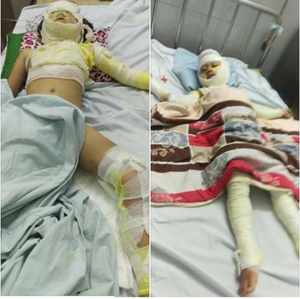 Do bị bỏng nặng, các nạn nhận đang được đội ngũ y bác sỹ chăm sóc, theo dõi tại bệnh viện.