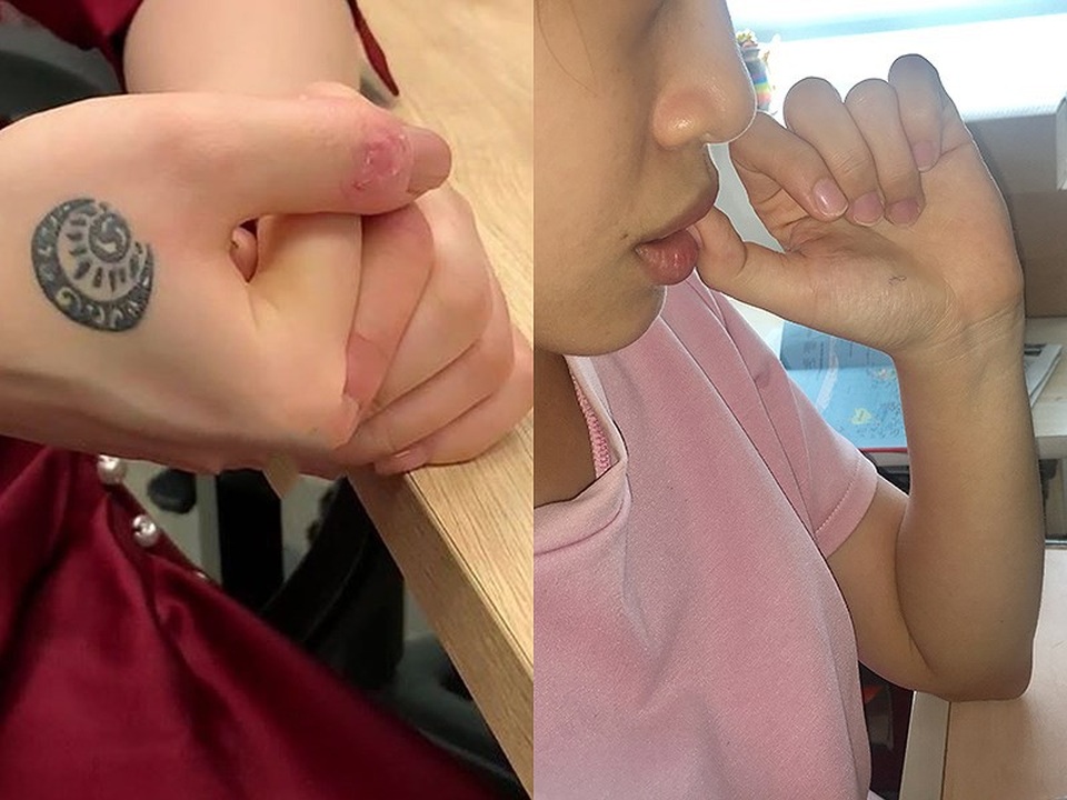 Tự cắt tay chảy máu để... tĩnh tâm - 1 Bàn tay Hương Tràm bị chính cô bóc hết da để giải tỏa căng thẳng. Chị H. thường lặp lại hành vi cắn môi bật máu mỗi khi căng thẳng. Ảnh: HL