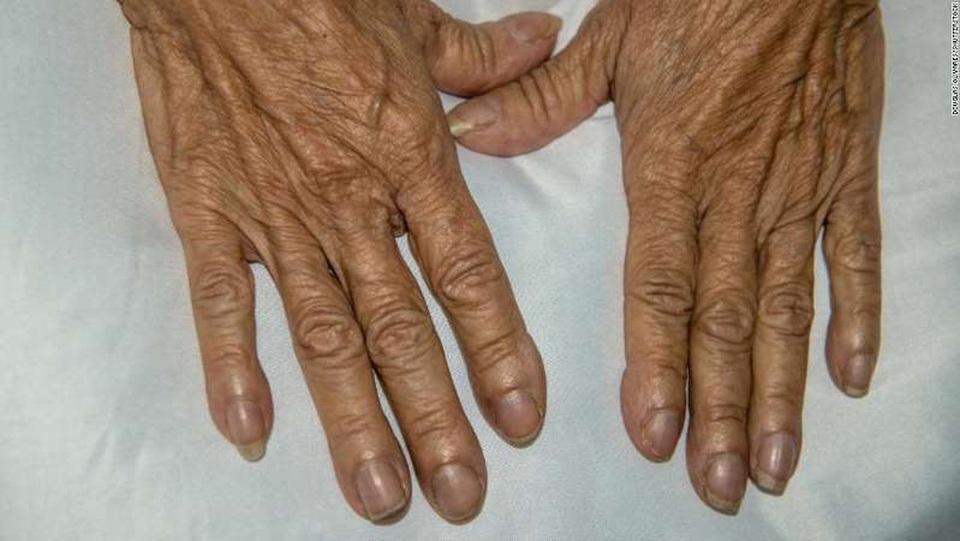 6 dấu hiệu bất thường báo bệnh tim - 1 Ngón tay dùi trống trên một bệnh nhân nữ