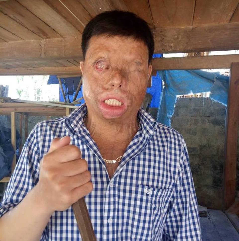 Cuộc sống khốn khổ của chàng trai có khuôn mặt biến dạng vì bị tạt axit nhầm - 2 Trong lúc đi chở hàng thuê, Khuyên đã bị người ta hắt cả ca axit nhầm vào mặt mình.