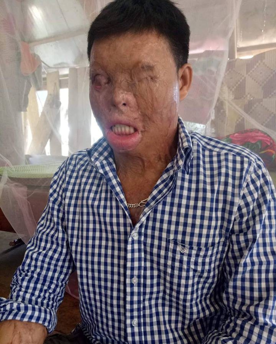 Cuộc sống khốn khổ của chàng trai có khuôn mặt biến dạng vì bị tạt axit nhầm - 1 Cuộc sống khốn khổ của chàng trai có khuôn mặt biến dạng vì bị tạt axit nhầm - 1