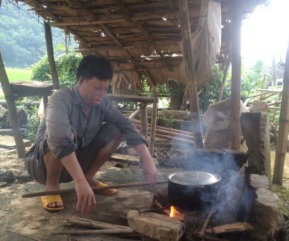 Cuộc sống khốn khổ của chàng trai có khuôn mặt biến dạng vì bị tạt axit nhầm - 3 Ánh sáng cuộc đời chàng trai trẻ khép lại khi mới ở tuổi ngoài 20.