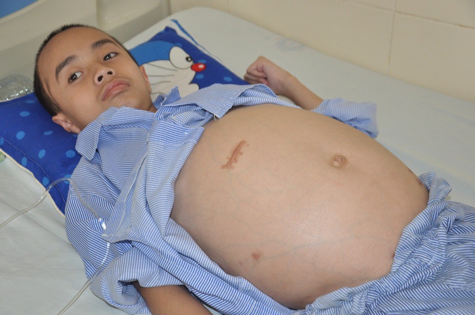 4 lần mổ não, tính mạng cậu bé 10 tuổi như ngọn đèn trước gió - 1 Cậu bé Hiếu đã trải qua 4 lần mổ não và chuẩn bị bước vào ca mổ lần thứ 5.