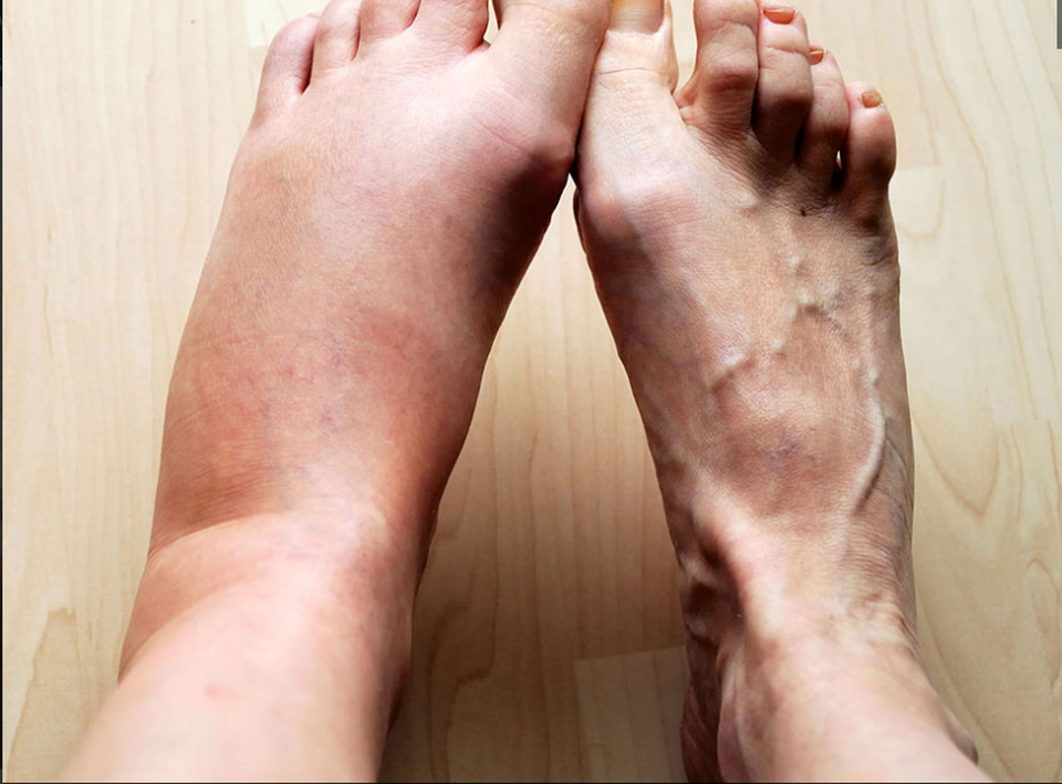 Tại sao cơ thể lại sưng khi bị viêm? - 1 Tại sao cơ thể lại sưng khi bị viêm? - 1