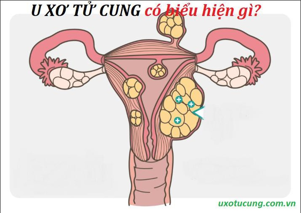 Dấu hiệu nhận biết sớm u xơ tử cung - 3 U xơ tử cung nếu phát hiện sớm có thể cải thiện tốt