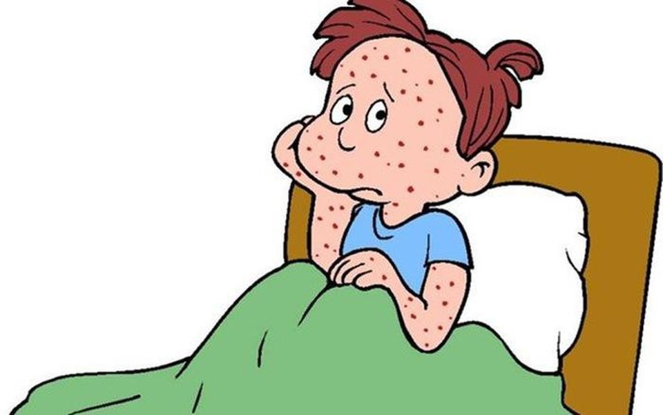 Người bị bệnh thủy đậu kiêng gì cho nhanh khỏi? - 4 Bệnh thủy đậu có thể để lại sẹo thâm lõm trên da