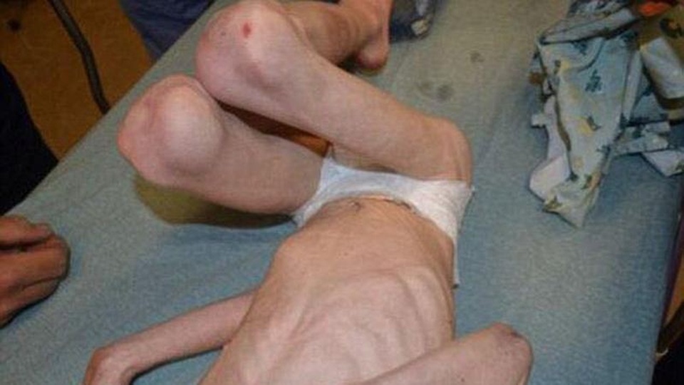 Rúng động vụ án mẹ kế tàn độc nhốt con chồng dưới gầm cầu thang, bỏ đói đến gần chết - 2
Cậu bé Jordan tại thời điểm được cảnh sát tìm thấy và giải cứu, chỉ còn da bọc xương.