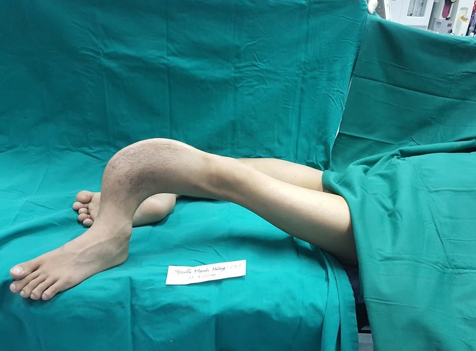 “Kéo dài” đôi chân cong như rễ cây giúp "Hoàng tử ếch" đi lại được sau 28 năm - 1 Đôi chân của bệnh nhân trước khi được phẫu thuật. Ảnh: BS cung cấp.