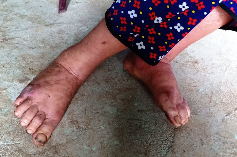 Cùng cực mẹ già mang bệnh sắp chết vẫn chăm con bại não từng ngày - 5 Bệnh viêm đa khớp khiến chân, tay bà Tâm sưng vù, mắt mờ, đau đớn và khó khăn đi lại.