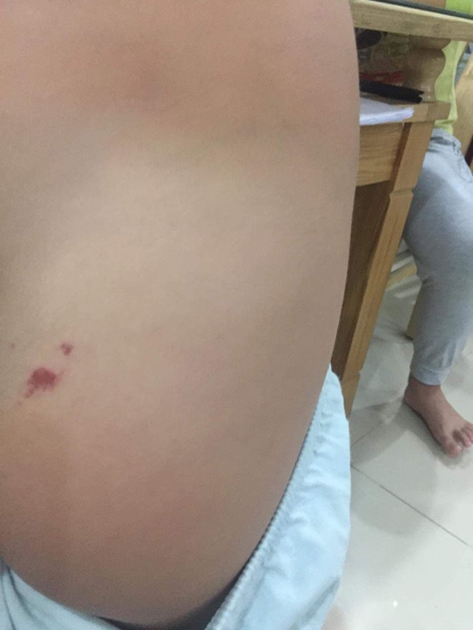 Bé mầm non tổn thương vùng kín: Nhà trường bảo “không liên quan tới cô giáo”? - 1
Một trong những vết bầm trên người cháu V. sau khi đi học về trước đó.
