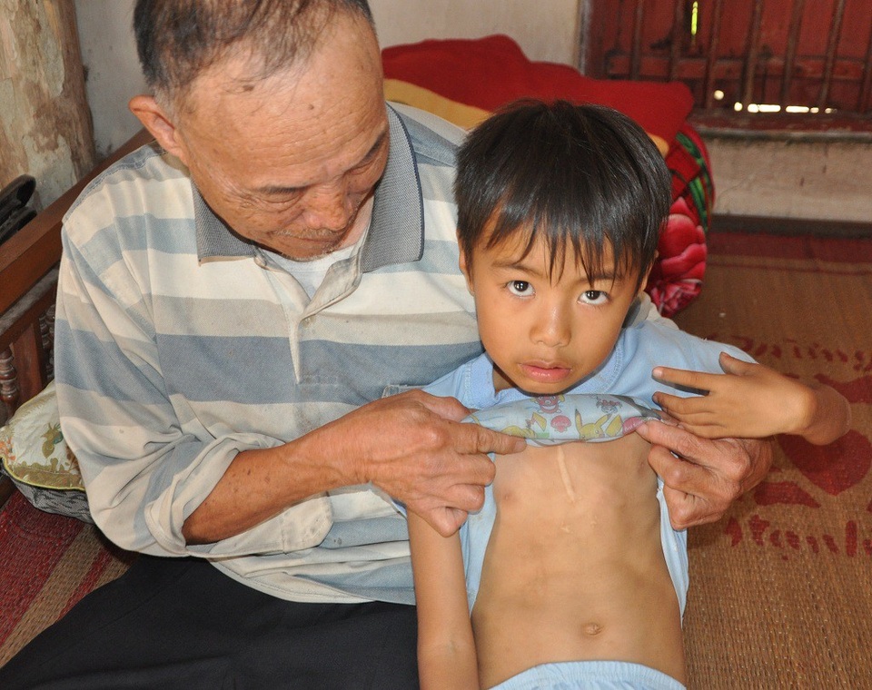 Đớn đau người mẹ trẻ ôm con bệnh tim quỳ lạy trước di ảnh của chồng - 6 Ca mổ lần trước vẫn còn để lại vết sẹo dài thì nay cậu bé Liệu lại tiếp tục phải điều trị.