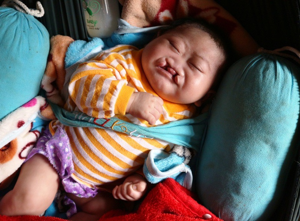Nỗi thống khổ của gia đình bị "trời đày" - 1 Bị hở hàm ếch bẩm sinh nhưng cháu Khánh chưa một lần được đến bệnh viện chữa trị.