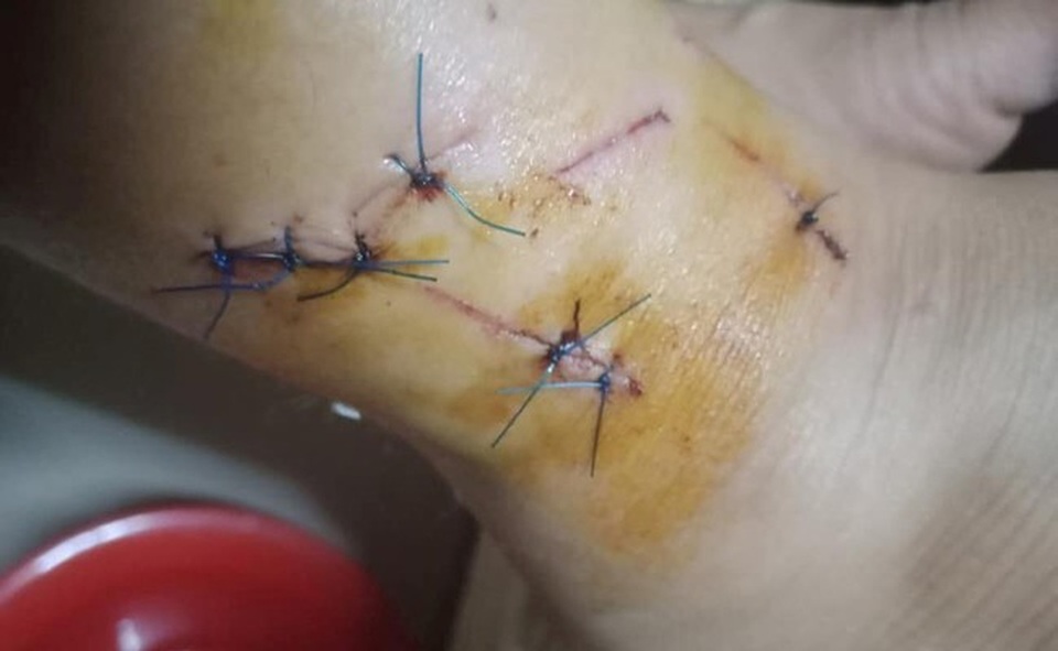 Một cán bộ quản lý thị trường bị tố đánh dân nhập viện tại Hà Tĩnh! - 2 Vết thương ở cổ chân chị Hiền được cho là do ông Nhật gây ra