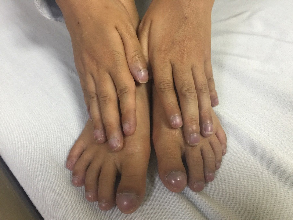 Chân tay cậu bé tím tái.