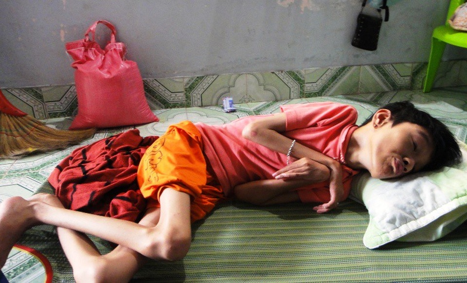 Chạnh lòng nhìn thiếu nữ xứ dừa chết mòn vì bại não - 1 Suốt 17 năm qua, em Trâm chỉ nằm một chỗ khiến ai nhìn thấy hình ảnh em cũng chạnh lòng, xót xa.