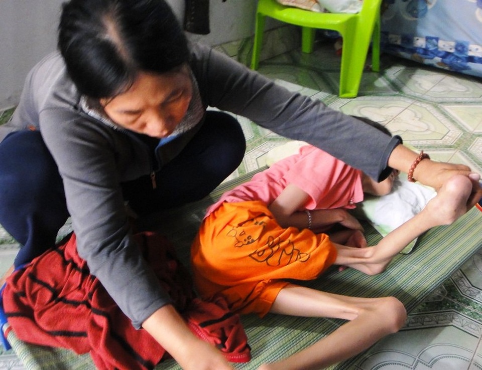 Chạnh lòng nhìn thiếu nữ xứ dừa chết mòn vì bại não - 3 Chân tay em Trâm co quắp nhìn thật xót xa.