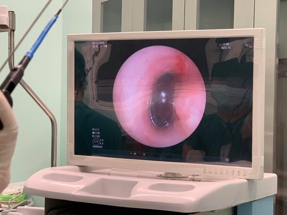 Bé 11 tháng tuổi tử vong vì hóc thạch - 1 Hạt hông xiêm được phát hiện trong phế quản bệnh nhi qua hình ảnh nội soi