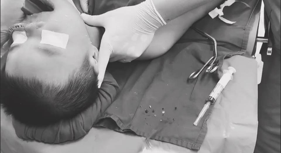 Bé 11 tháng tuổi tử vong vì hóc thạch - 2 Bệnh nhi đã may mắn qua nguy kịch khi bác sĩ kẹp vỡ hạt gắp ra ngoài, khơi thông đường thở