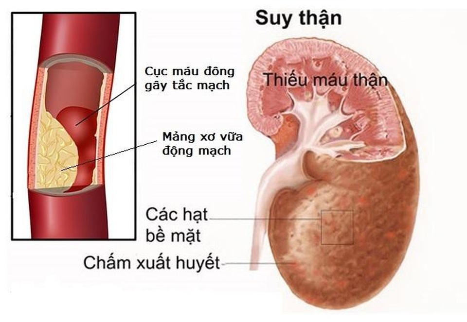 Biến chứng xơ vữa động mạch do rối loạn lipid máu nguy hiểm ra sao? - 4 Suy thận do biến chứng rối loạn lipid máu