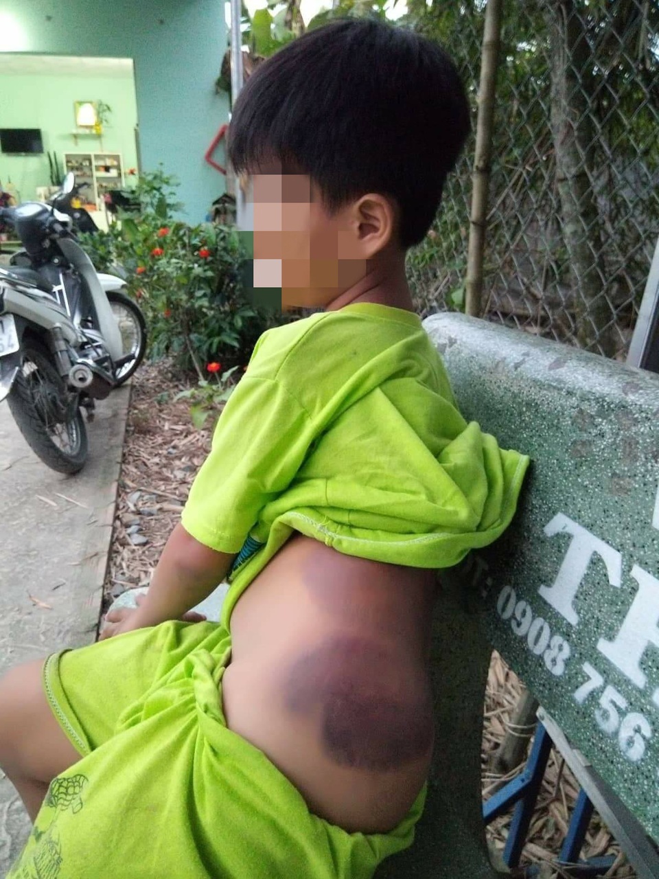 Long An: Học sinh lớp 1 bị cô giáo đánh bầm người - 1 Cháu K. bị cô giáo V. đánh bầm người nhưng không dám khóc.