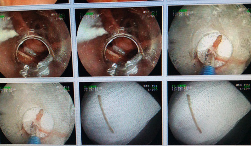 Nghẹn thở, nuốt đau vì hóc xương vịt - 1 Xương vịt được lấy ra khỏi thực quản cho bệnh nhân H.