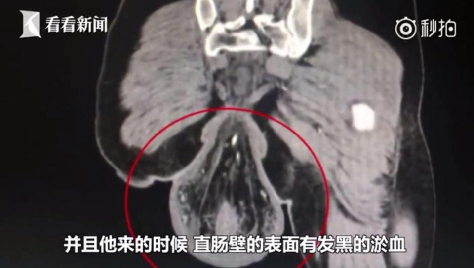 Rơi cả ruột ra ngoài vì mải chơi game khi đi vệ sinh - 1 Ruột rơi ra ngoài cơ thể sau khi chơi game trong nhà cầu