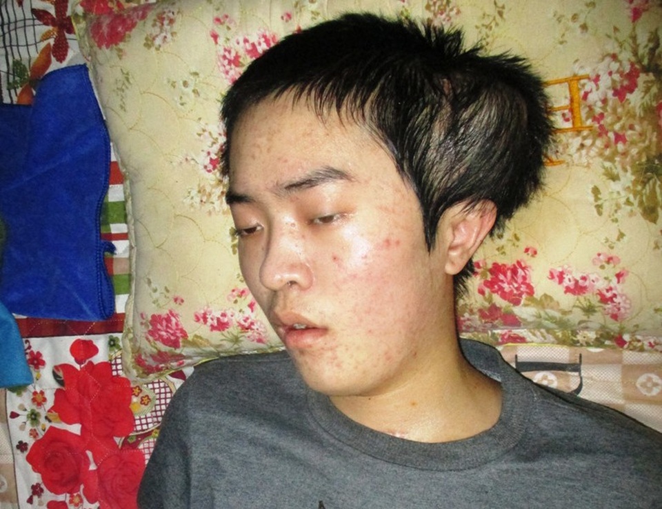 Bố rao bán thận cứu con bị u não - 1 Khối u trên đầu Tùng ngày một phát triển to, gây nguy hiểm đến tính mạng