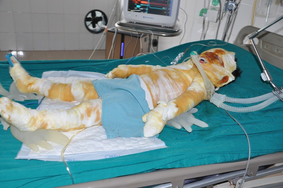 Bị bỏng nặng đến 82% cơ thể, bé Quỳnh Như (4 tuổi) đang phải trong tình trạng rất nặng.