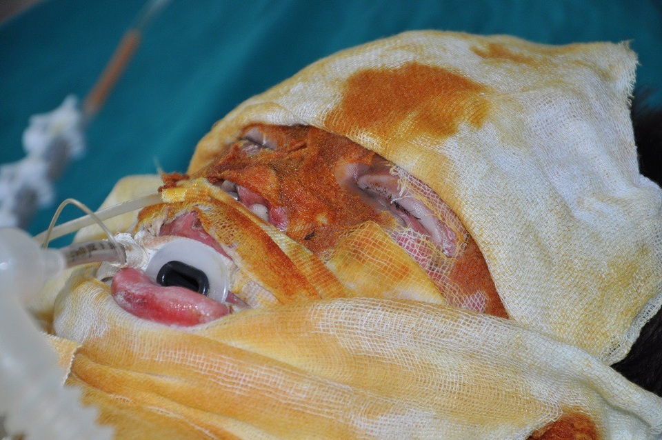 Em có 25% bỏng sâu độ 4 nên rất nan giải trong việc chữa trị.