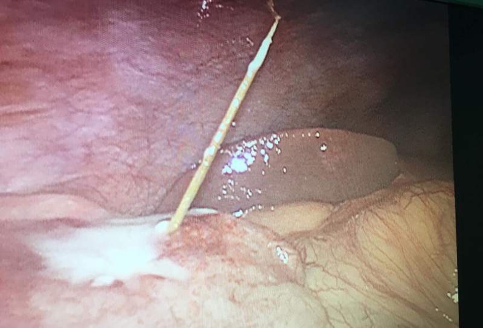 Thủng ruột non vì không biết nuốt tăm lúc nào - 1 Tăm xỉa răng đâm thủng ruột non nam thanh niên 31 tuổi