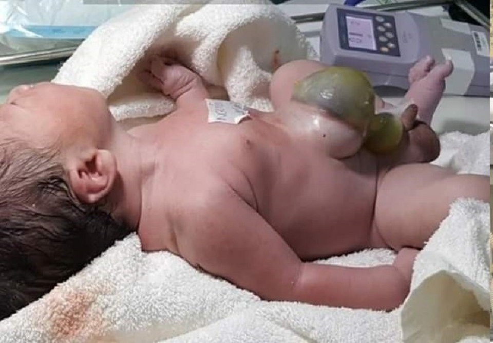 Liên tiếp 2 bệnh nhi chào đời với nội tạng nằm ngoài thành bụng - 1 Trường hợp thứ nhất là bé trai có ổ thoát vị cuống rốn chứa gan và ruột