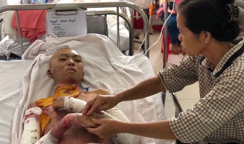 Sự sống mong manh của thanh niên nghèo bị thiêu sống - 4 Thời gian điều trị còn dài, di chứng bỏng để lại cho bệnh nhân sẽ rất nặng nề