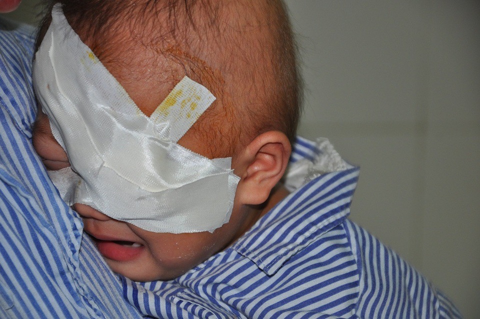 Tiếng khóc xé lòng của bé 2 tuổi bị ung thư võng mạc - 1 Vừa trải qua ca phẫu thuật khoét bỏ mắt trái nên cô bé Tuyết khóc dữ dội.