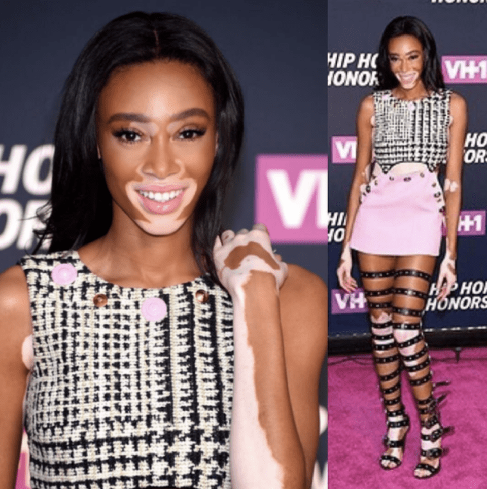 Winnie Harlow quyến rũ với váy xuyên thấu - 7 
Cô gái người Canada trở thành cái tên hot trong cuộc thi America’s Next Top Model và dù không giành chiến thắng cao nhất nhưng cô vẫn trở thành người mẫu nổi tiếng