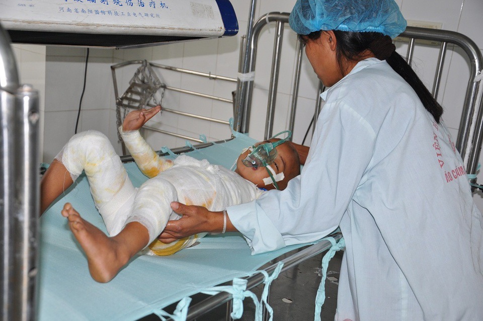 Ngã vào nồi cám lợn, bé 4 tuổi nguy kịch tính mạng - 1 Bị bỏng do ngã vào nồi cám lợn khiến tính mạng bé Long nguy kịch.