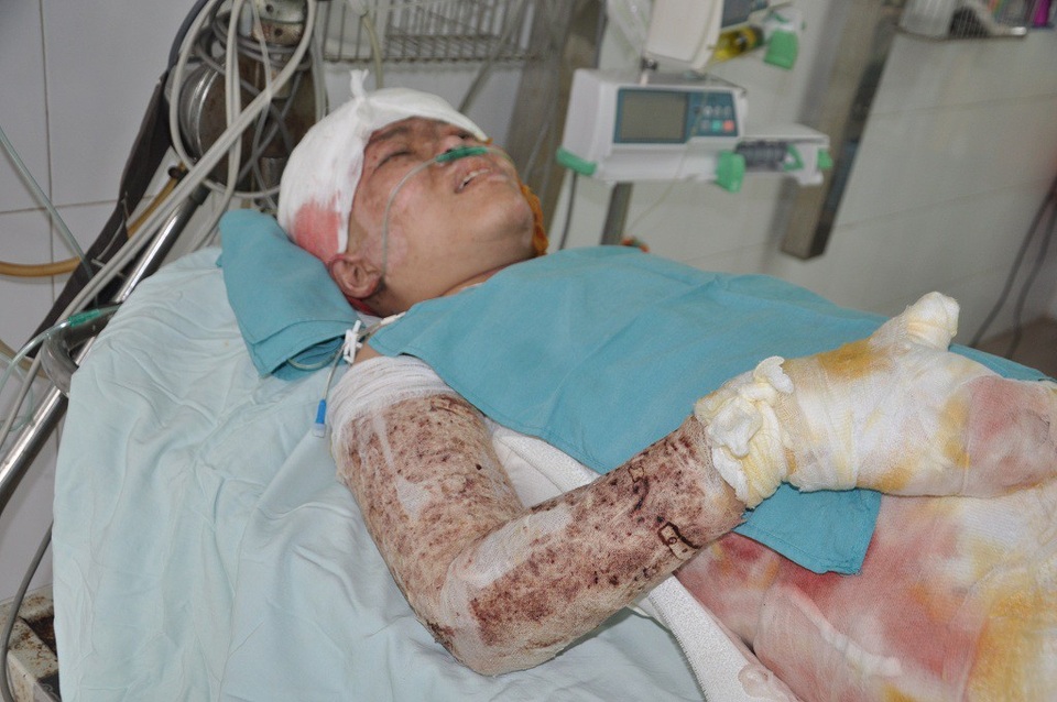 Nổ gas kinh hoàng, người mẹ trẻ nguy kịch tính mạng - 5 Bị được chuyển cấp cứu từ bệnh viện Chợ Rẫy ra Viện bỏng quốc gia trong tình trạng nhiễm khuẩn, nhiễm trùng nặng.
