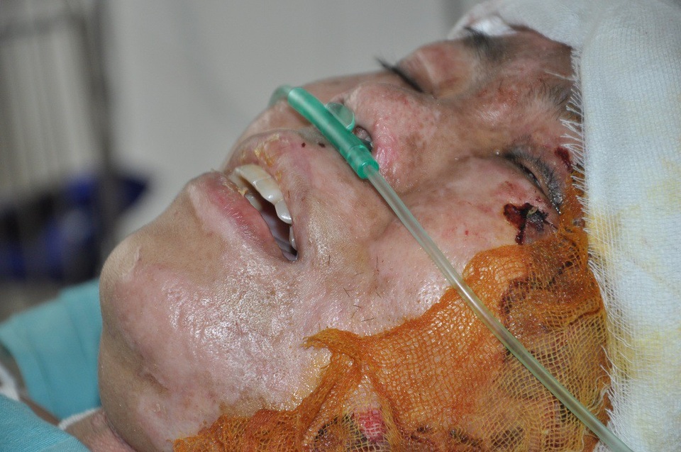 Nổ gas kinh hoàng, người mẹ trẻ nguy kịch tính mạng - 2 Tại bệnh viện em cứ liên tục mê sảng, sốt.