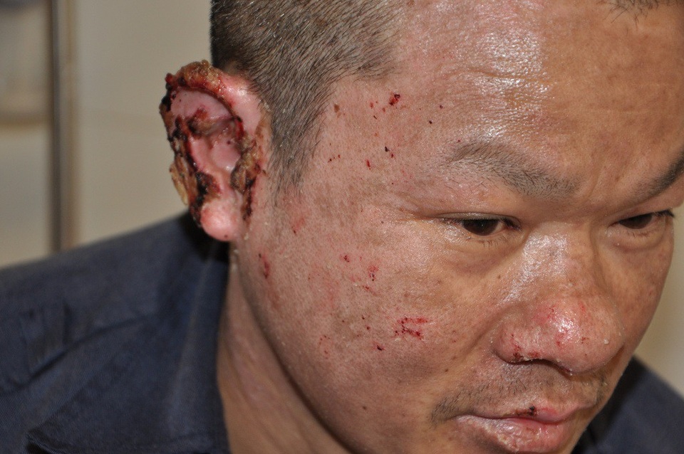 Thiếu 70 triệu đồng, người mẹ trẻ chấp nhận nằm nhà chờ chết vì không vay được tiền - 5 Gương mặt của anh còn loang lổ sau vụ bỏng.