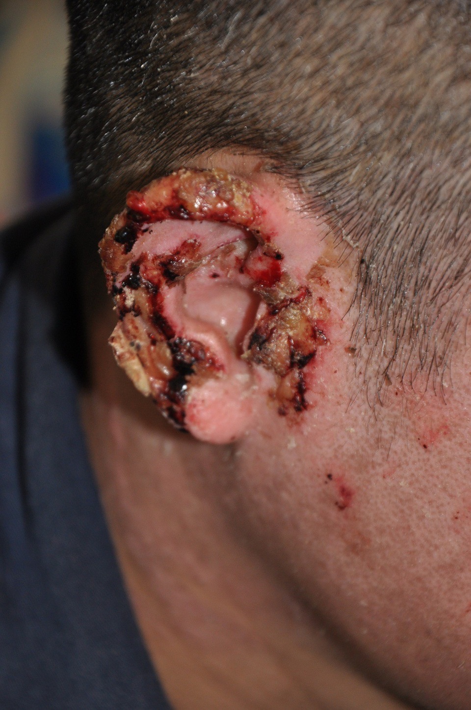 Thiếu 70 triệu đồng, người mẹ trẻ chấp nhận nằm nhà chờ chết vì không vay được tiền - 7 Chăm vợ, bản thân anh Điều vẫn còn đau nhiều với 1 phần bên tai còn chưa được điều trị đến nơi đến chốn.