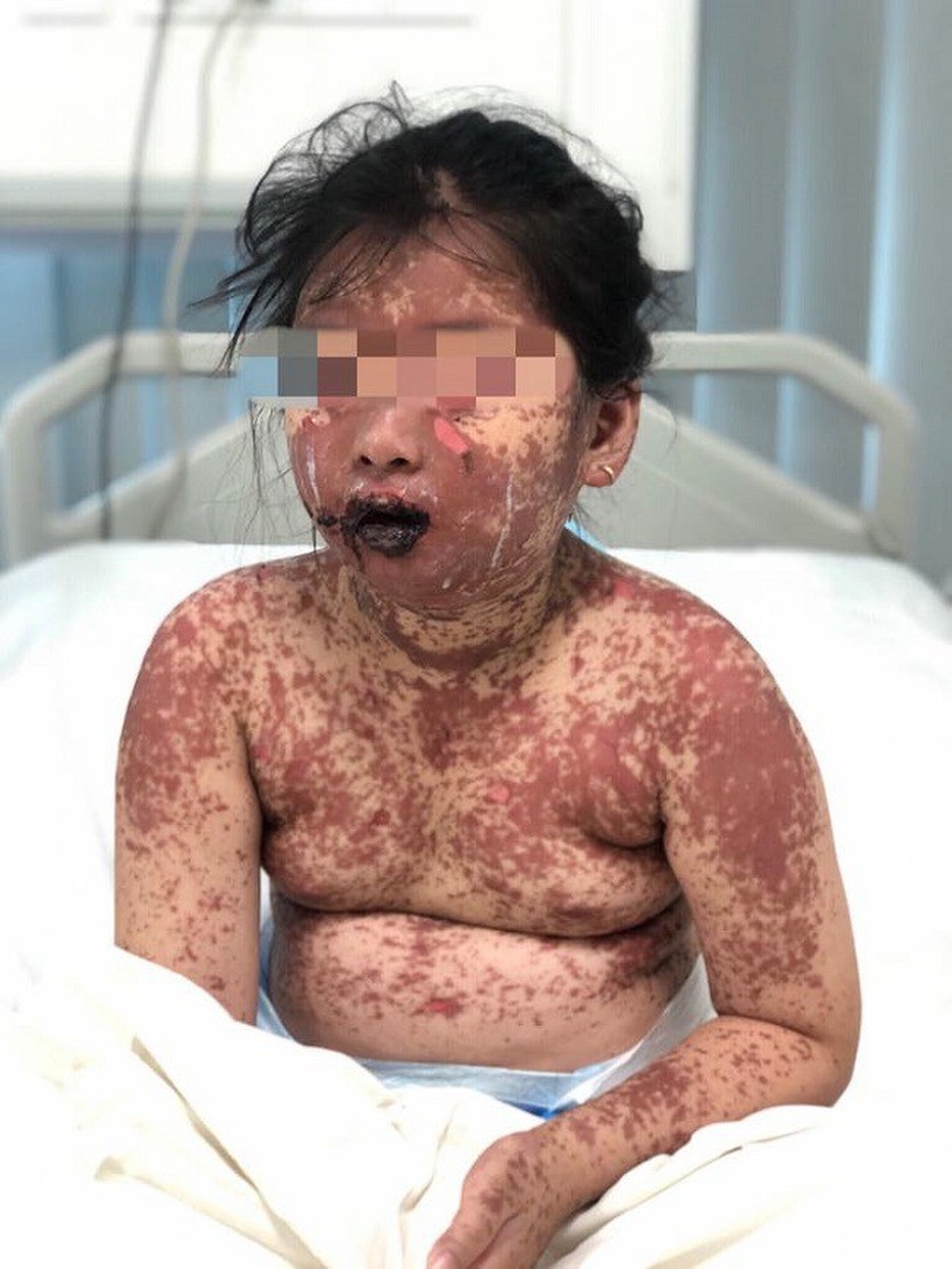 Bé gái 7 tuổi lở loét toàn thân sau khi uống thuốc mua ở phòng mạch tư - 1 Cơ thể bệnh nhi lở loét như nạn nhân bị bỏng nặng do mắc hội chứng hiếm gặp