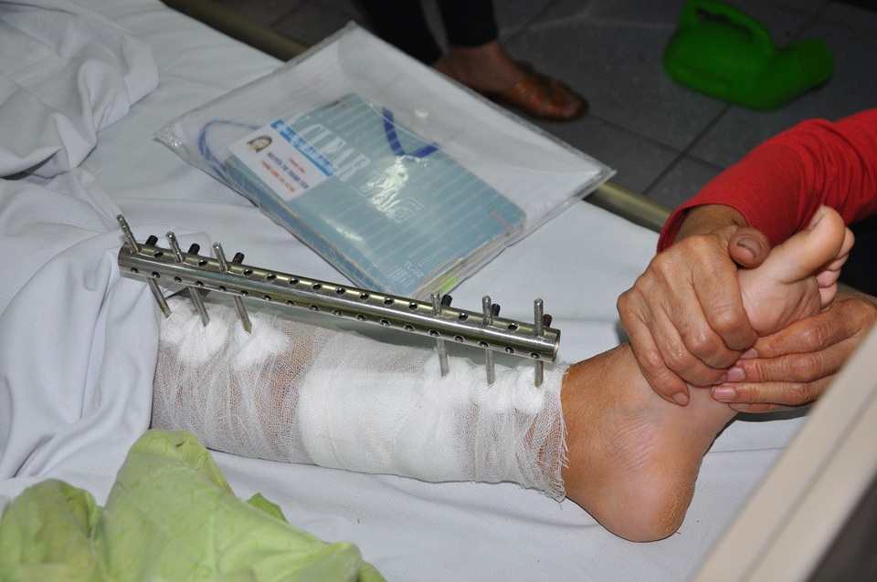 Bên chân bị đóng đinh của em phải mất từ 3-6 tháng nữa mới hồi phục.