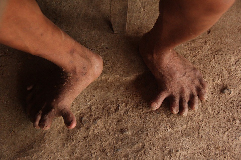 Kỳ lạ gia đình có 14 ngón chân, 12 ngón tay - 3 Bị dị tật nên những thành viên trong gia đình anh Hồ Cao đều không thể đi giày, dép